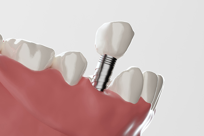 インプラントの構造イメージ